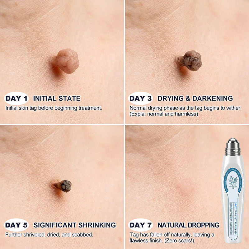 Precise, no-drip rollerball care for rough, raised-looking spots—choose your bundle and get the same amount free. ✨